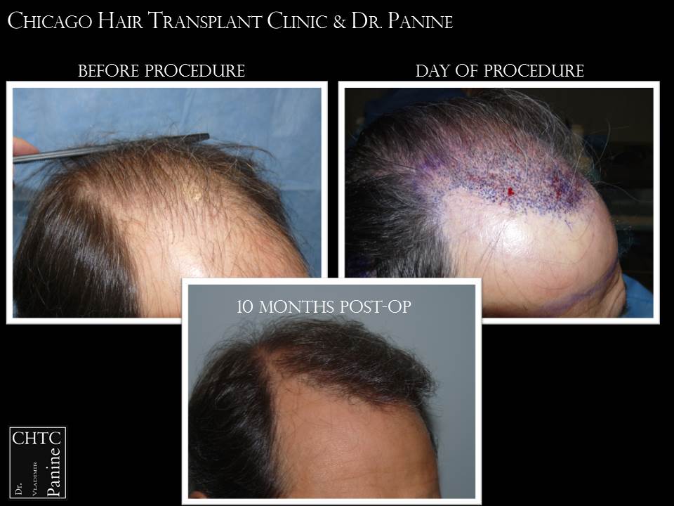 Vladimir V. Panine, MD - Chicago Hair Transplant Clinic - 1,749 Graft FUE  Results 